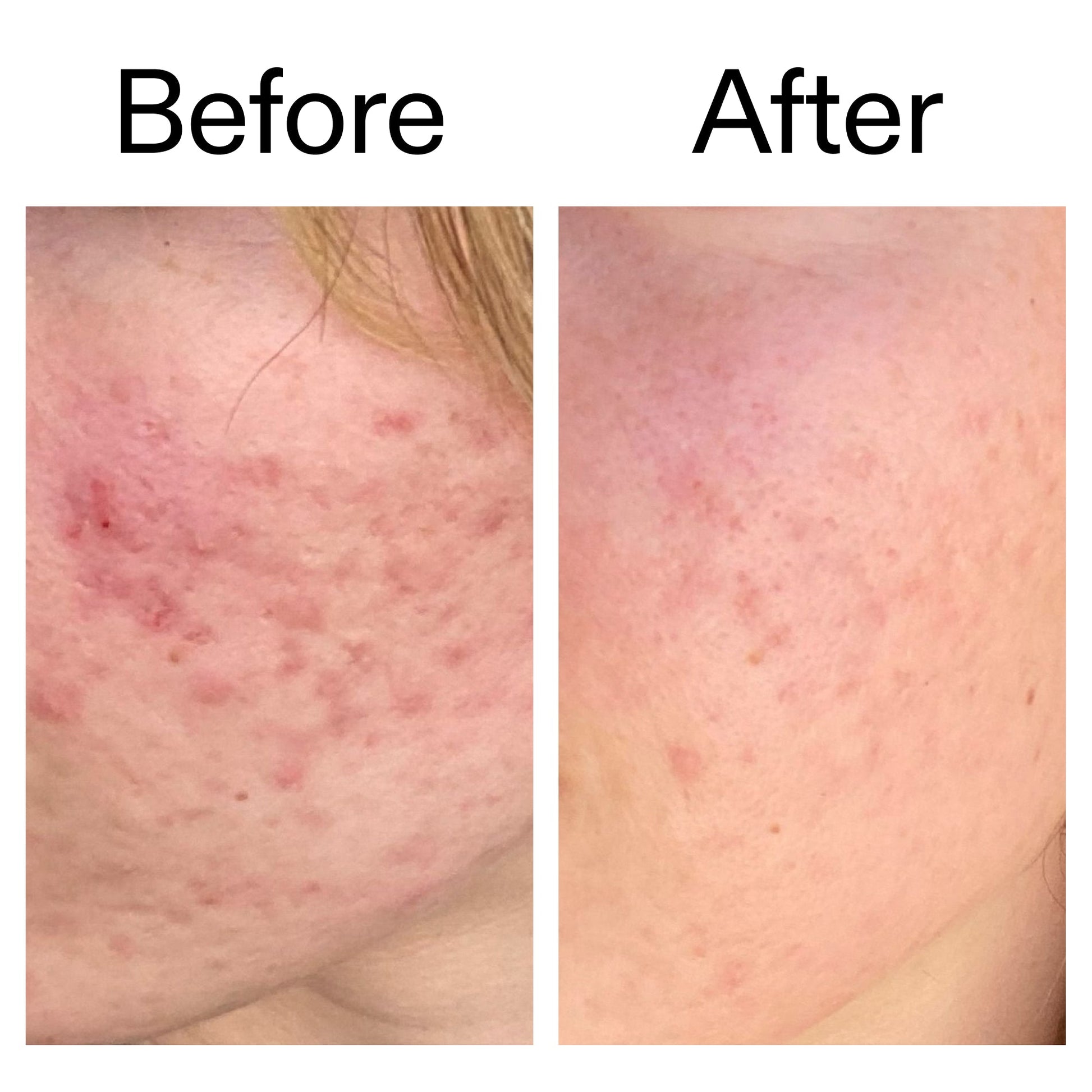 10-azelaic-acid-serum-for-redness-relief-l5 Azealic_Acid_Serum_B_A_Ppage_2000_x_2000.jpg