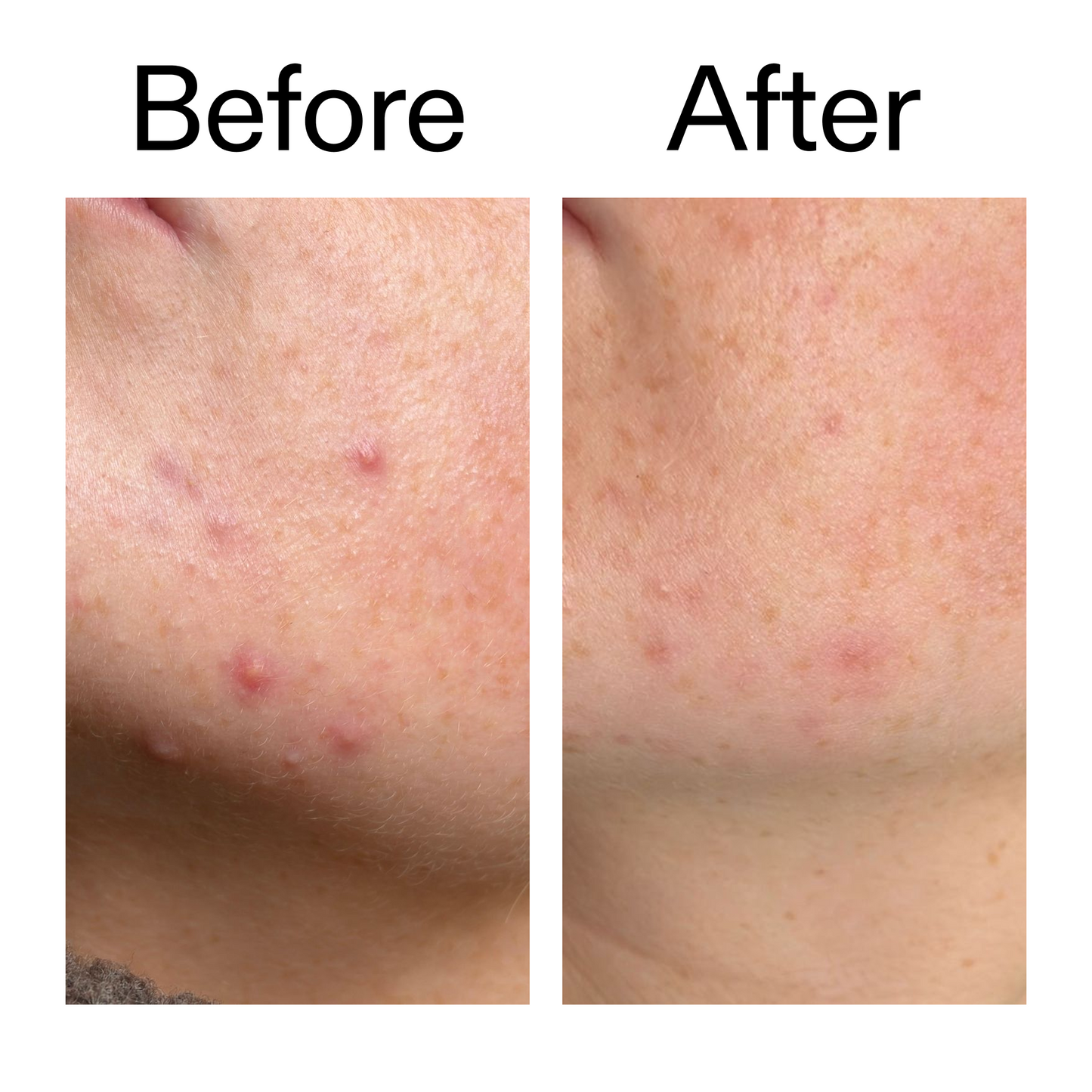 10-azelaic-acid-serum-for-redness-relief-l5 B_A_1_PPAGE.png