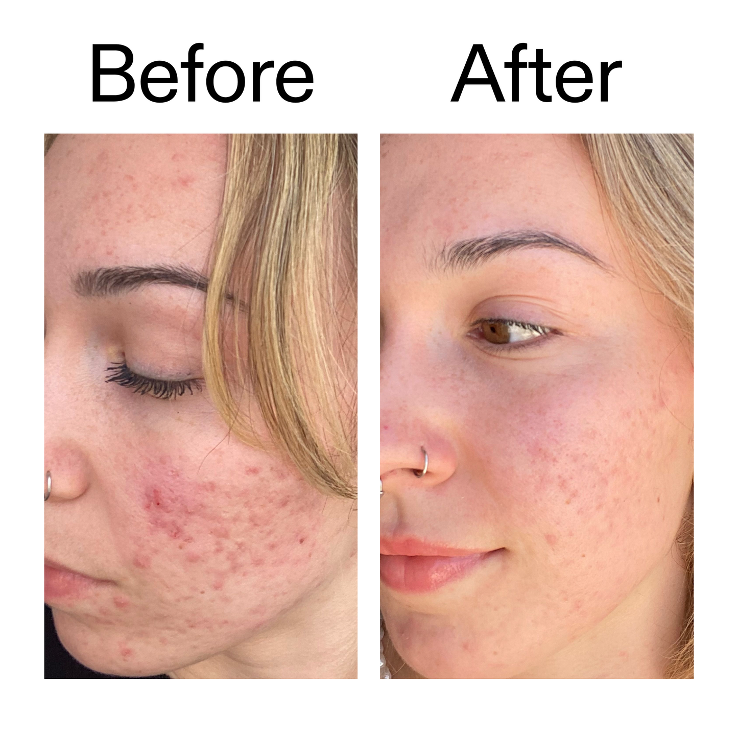 10-azelaic-acid-serum-for-redness-relief-l5 B_A_2_PPAGE.png