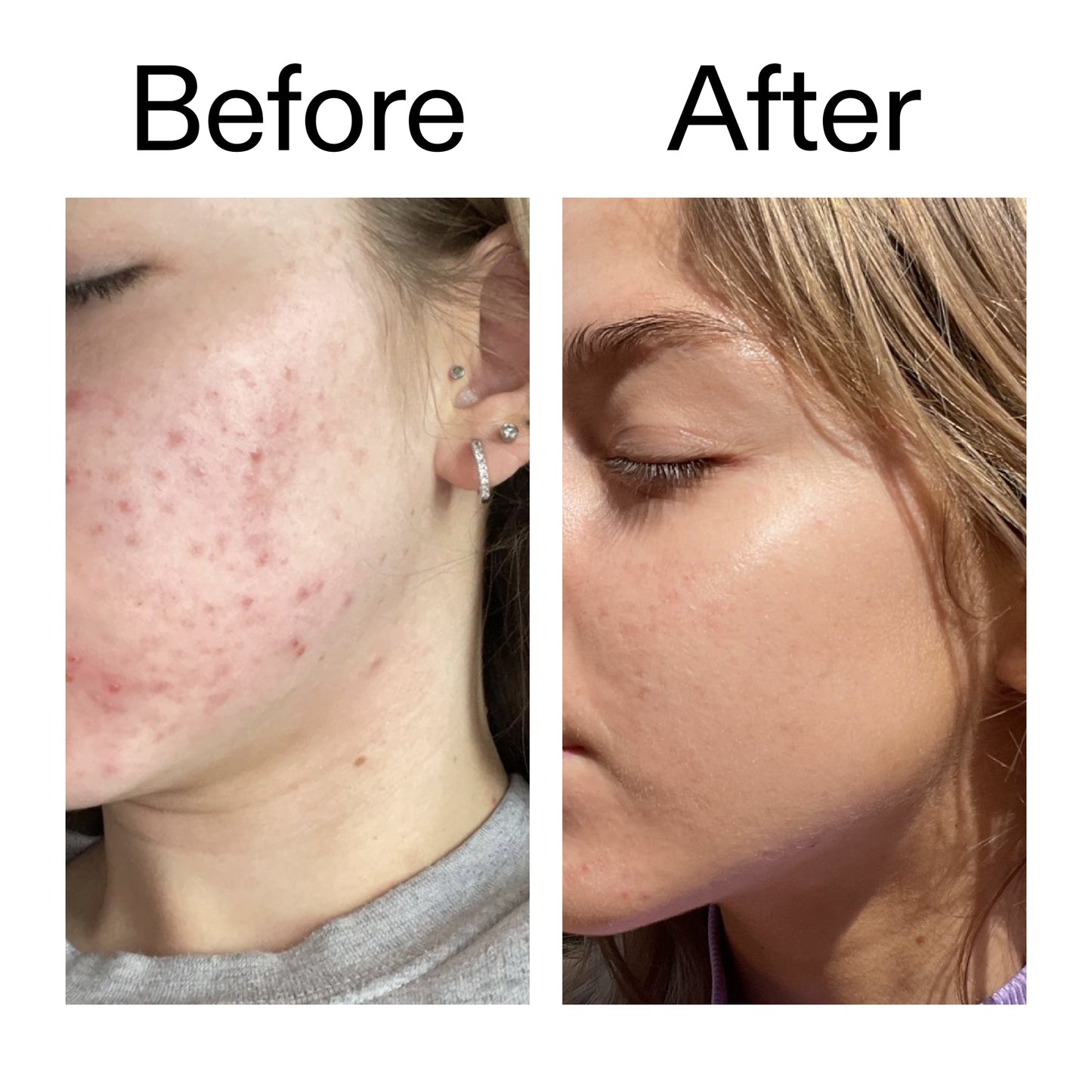 beta-hydroxy-acid-bha-serum-a5 Beta_Hydroxy_Acid_Serum_Before_After_2000x2000_96fda3e5-938d-49ef-bcf2-a0fa6ece4e2c.jpg