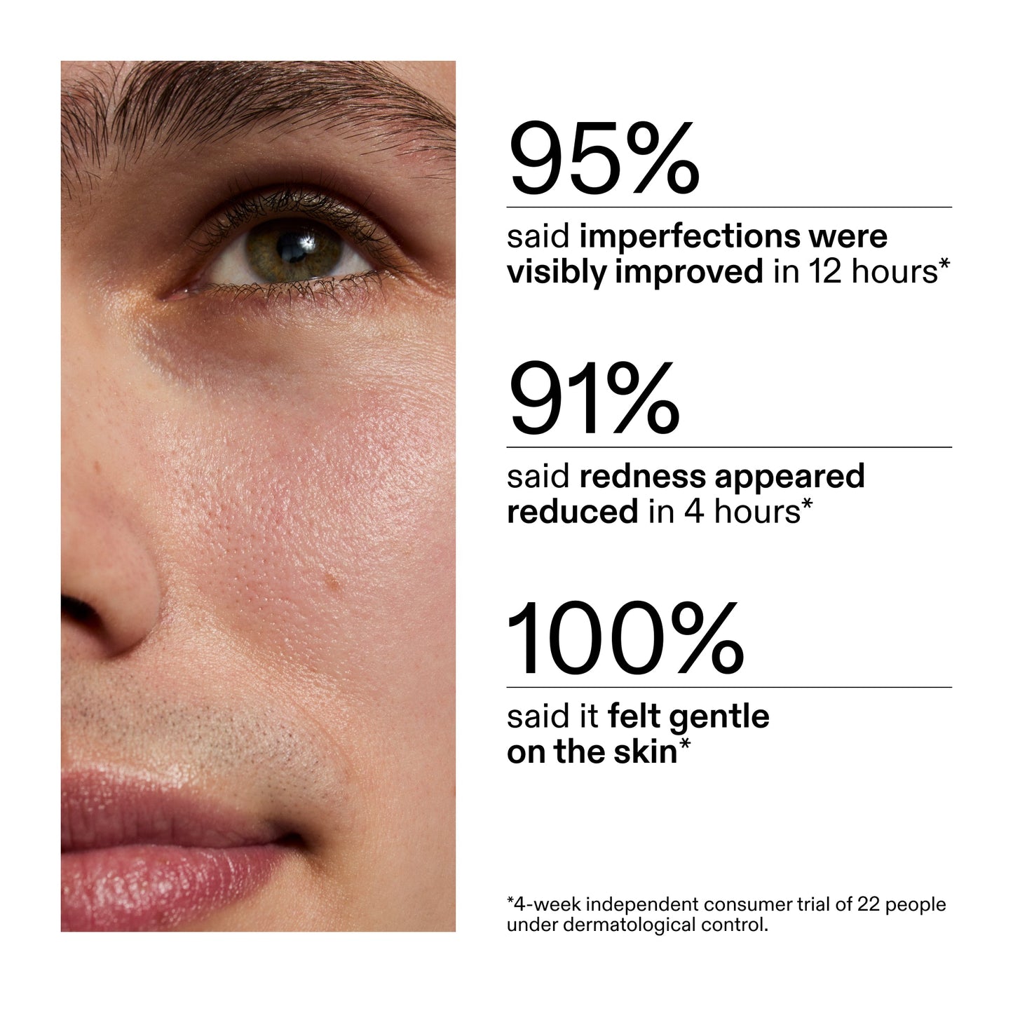 succinic-acid-acne-treatment-b4 CA_Succinic_Acid_Treatment_key_Claims_2000x2000_db91b0f1-7f29-4bfe-bb16-63a47f500960.jpg