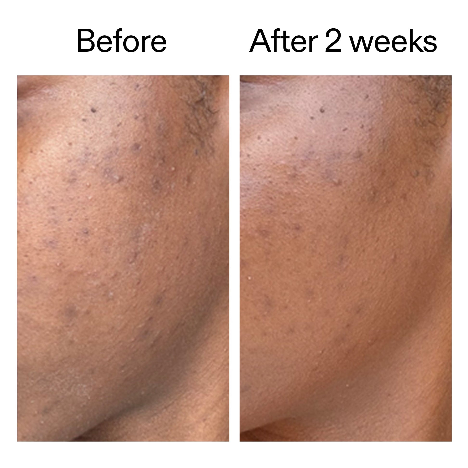 360-acne-clearing-serum-g2 DIOICB_A2000x2000.jpg