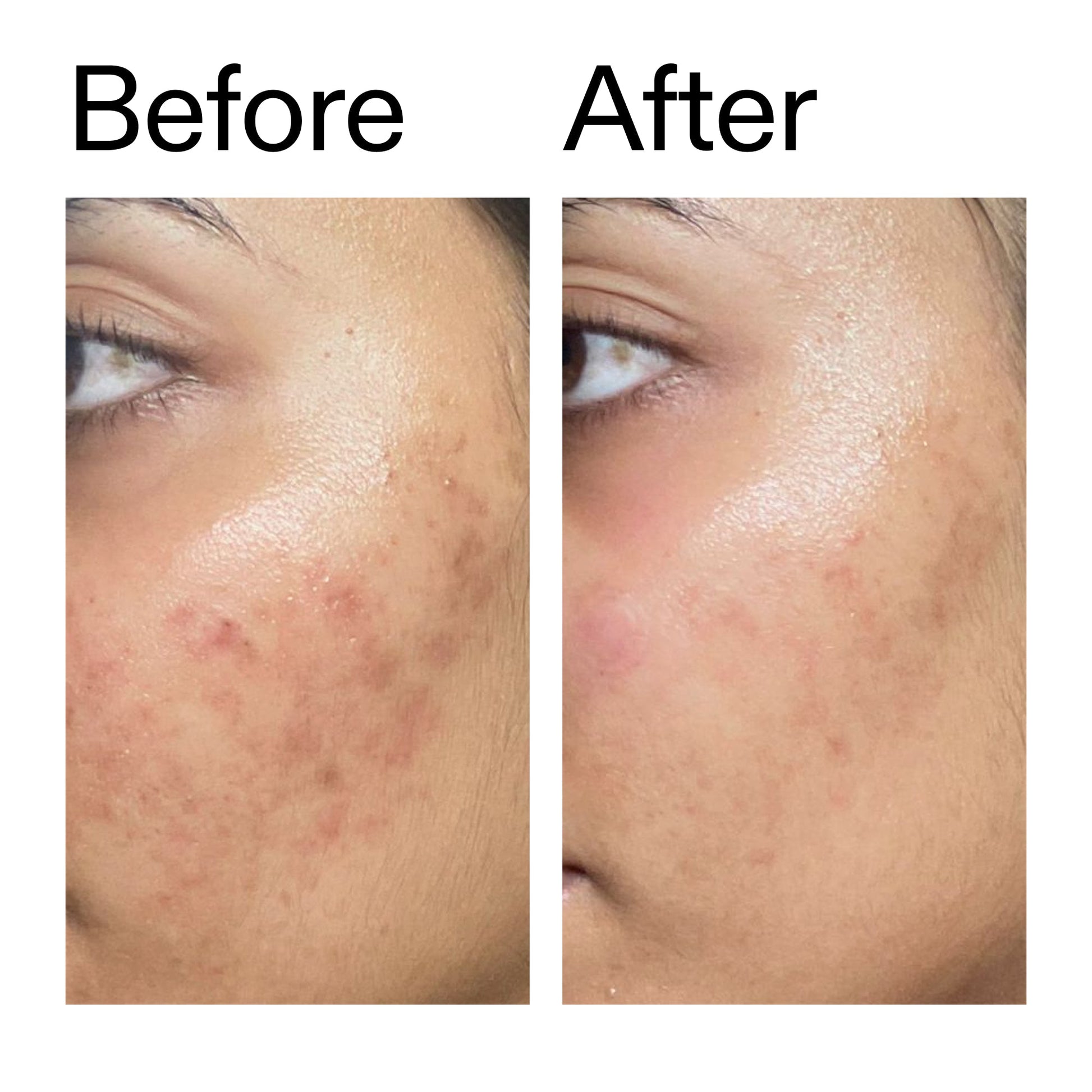 ectoin-hydro-barrier-serum-v3 Ectoin_Hydro-barrier_Serum__Before_After_2000x2000_34261920-d004-48d0-9c7b-8e1c15971bfd.jpg