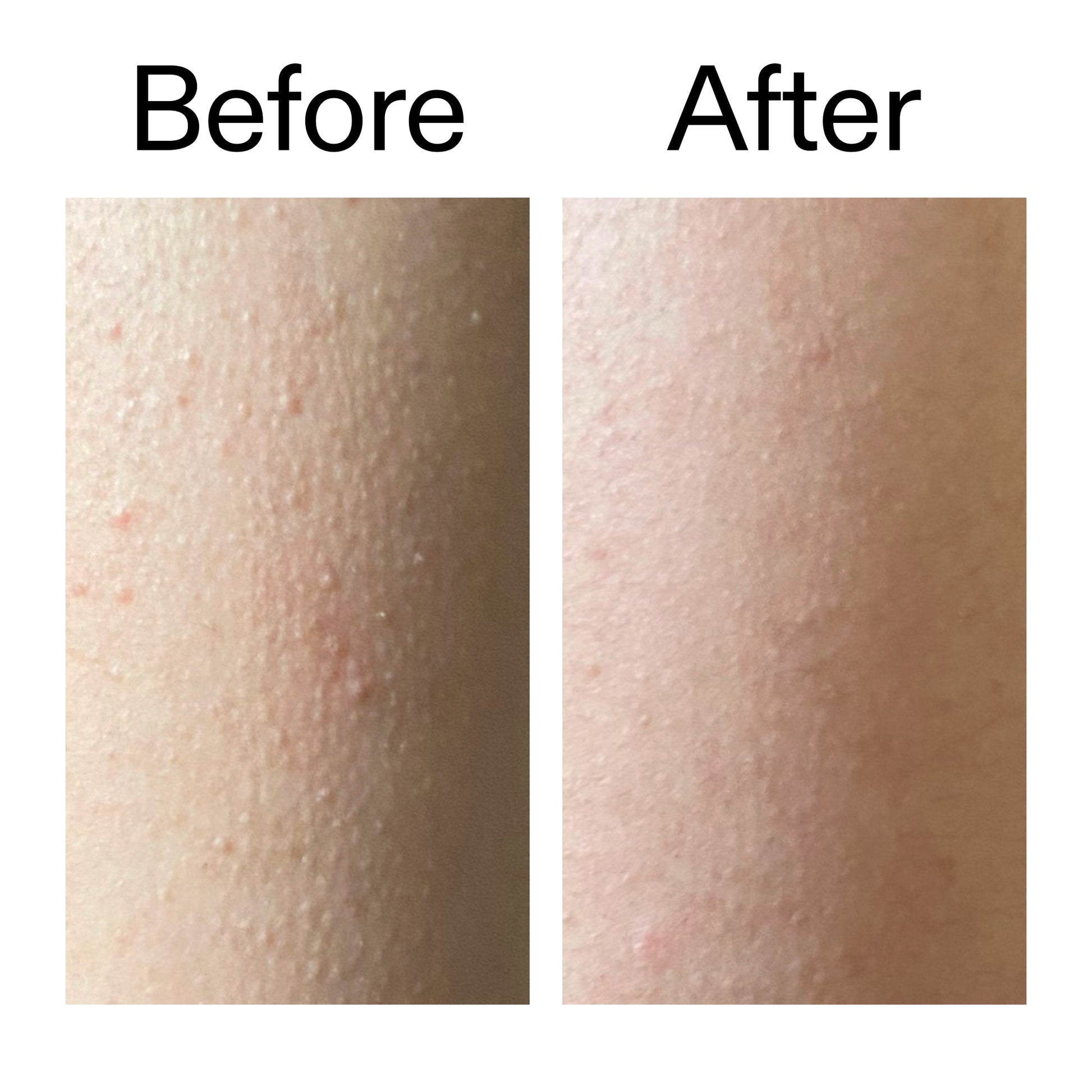 glycolic-acid-exfoliating-body-stick-duo-q0 Glycolic_Acid_Exfoliating_Body_Stick_Before_After_V2_2000x2000_2e4ba052-94f6-4d56-82df-7bdb5b2df7ae.jpg