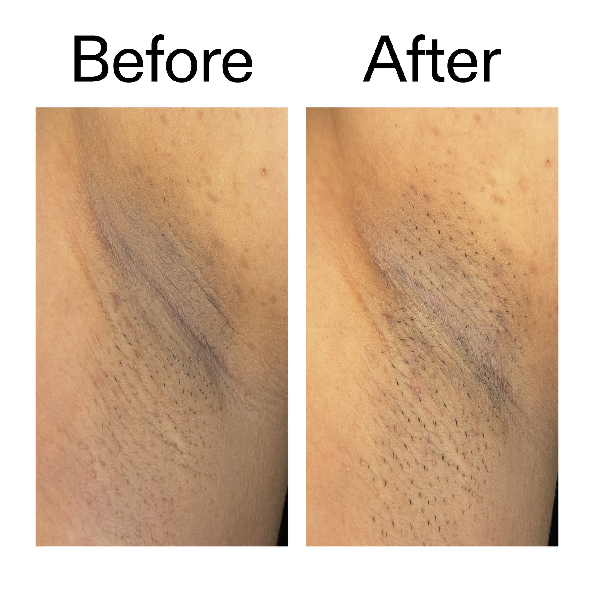 glycolic-acid-exfoliating-body-stick-duo-q0 Glycolic_Acid_Exfoliating_Body_Stick_Before_After_V3_2000x2000_ea919cd9-1439-4a46-82a0-76200eb5bb42.jpg