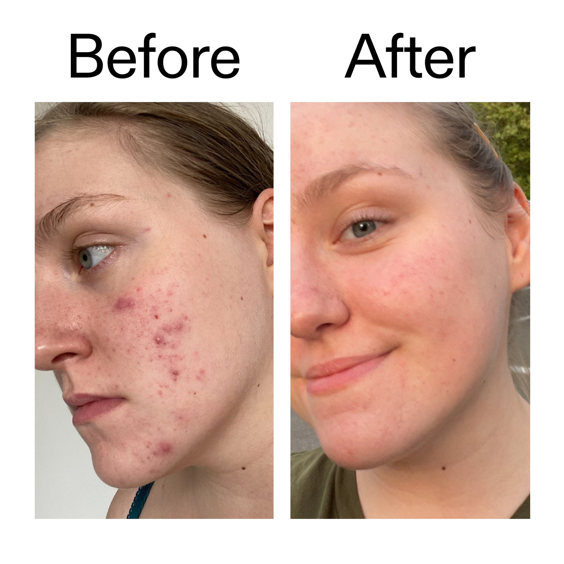 glycolic-acid-toner-t1 Glycolic_Acid_Toner_Before_After_2000x2000_49f0b9f7-e71b-4b2e-a8f8-2ea4b73247bb.jpg