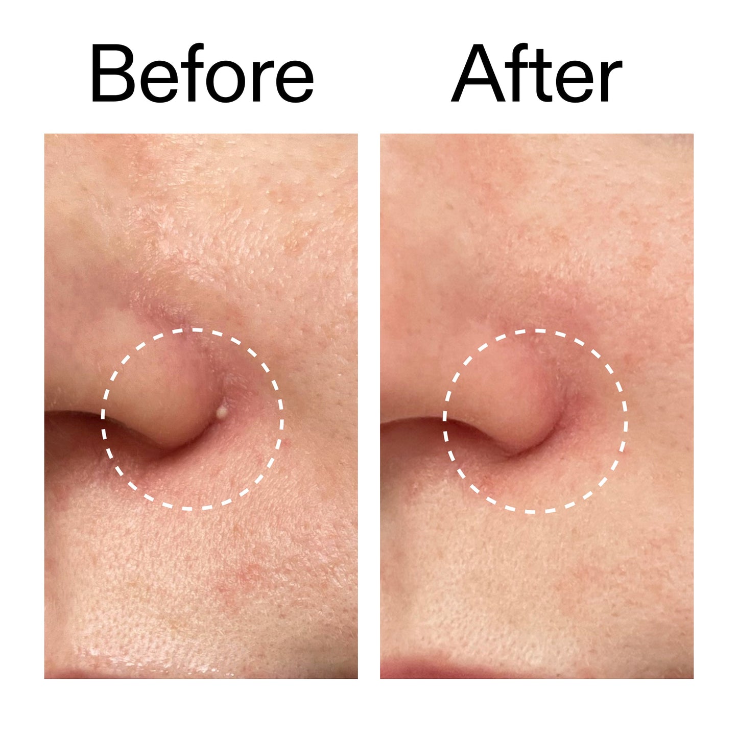 hydrocolloid-invisible-pimple-patches-pack-of-44-w6 Hydrocolloid_Invisible_Pimple_Patches_Before_After_2000x2000_b02aa37b-c78a-4682-91de-9135af5bb7df.jpg