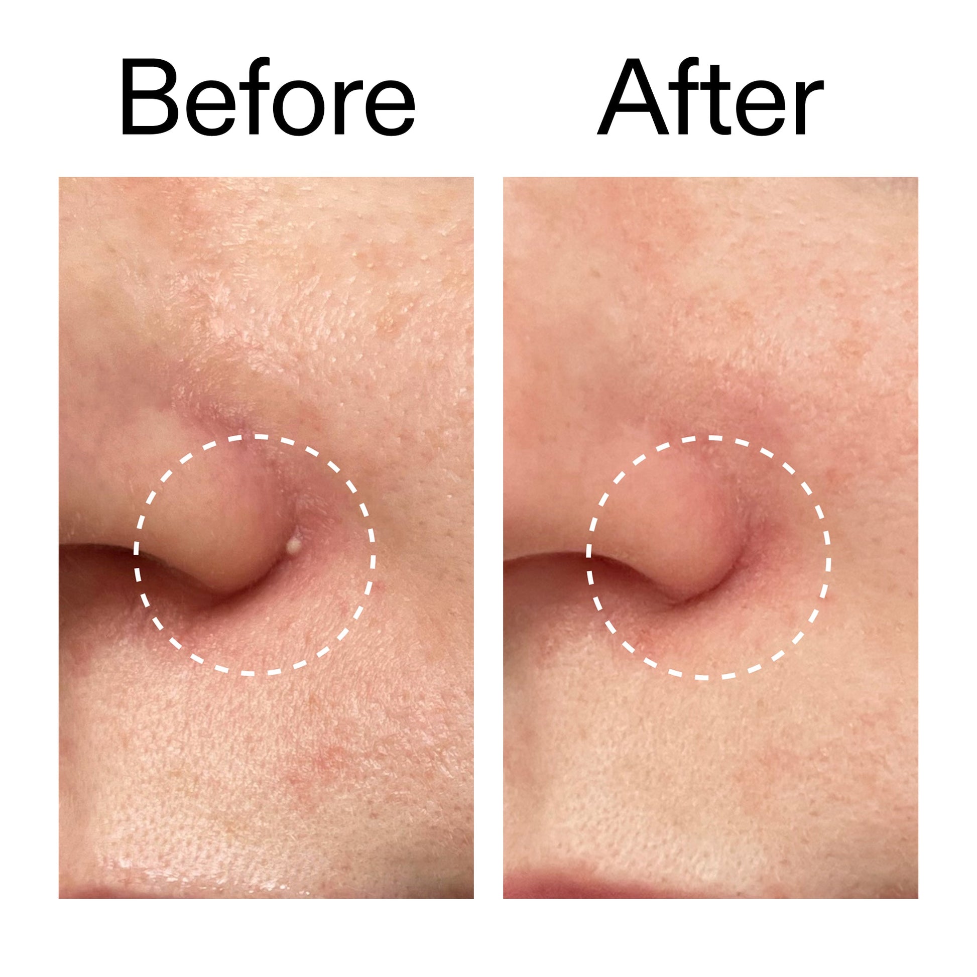 hydrocolloid-invisible-pimple-patches-pack-of-44-w6 Hydrocolloid_Invisible_Pimple_Patches_Before_After_2000x2000_b02aa37b-c78a-4682-91de-9135af5bb7df.jpg