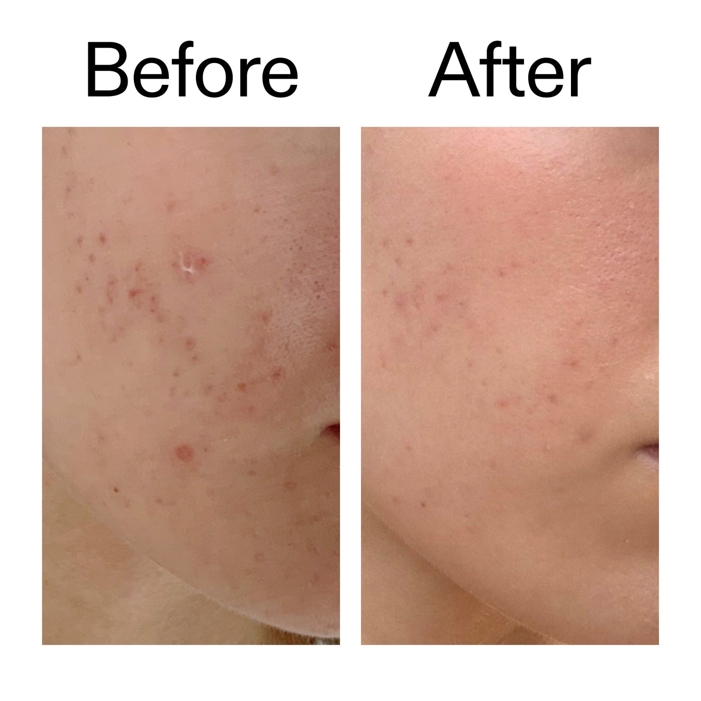 mandelic-acid-treatment-o3 Mandelic_Acid_Treatment_Before_After_2000x2000_4885ac6e-c5d7-4279-a72a-1417af7dce35.jpg