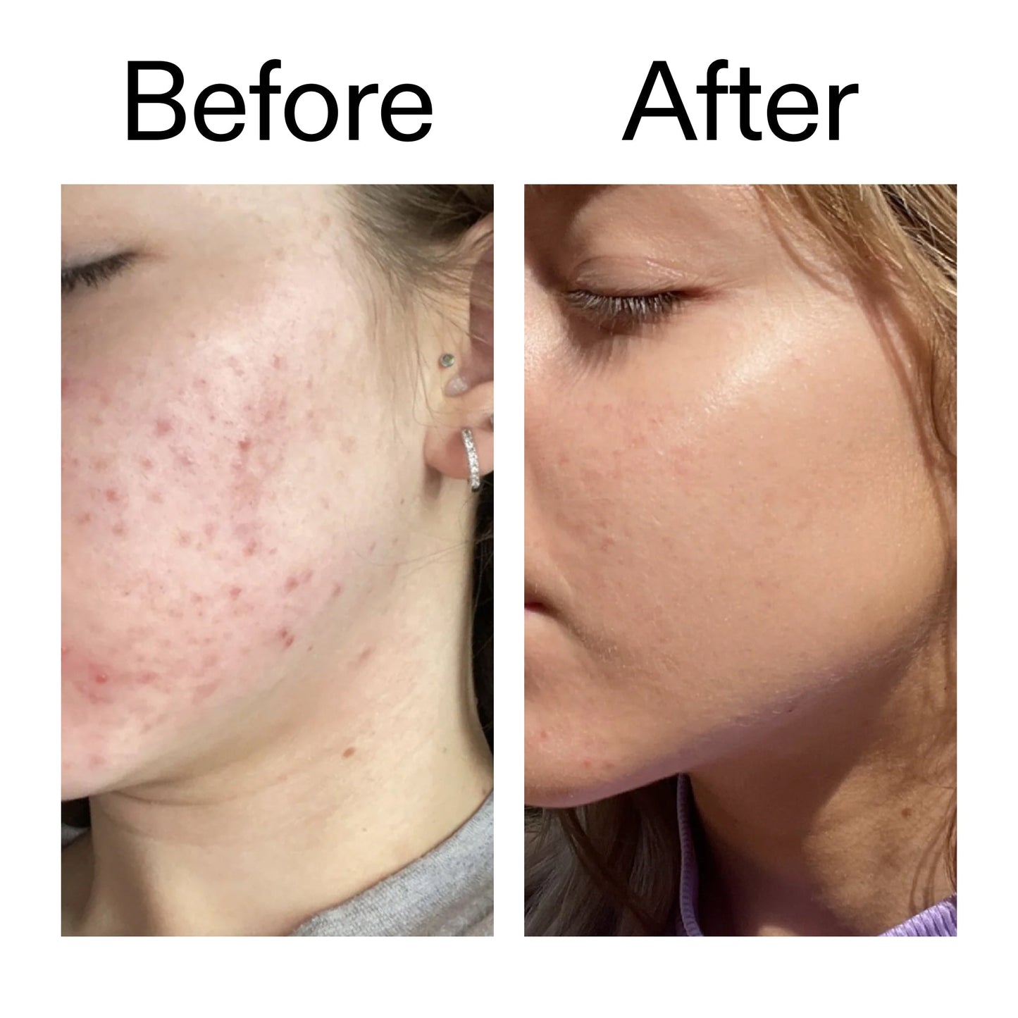 10-niacinamide-serum-duo-b1 Niacinamide_Serum_Before_After_2000x2000_bde32455-9e7d-448e-b053-bef41504f0a9.jpg