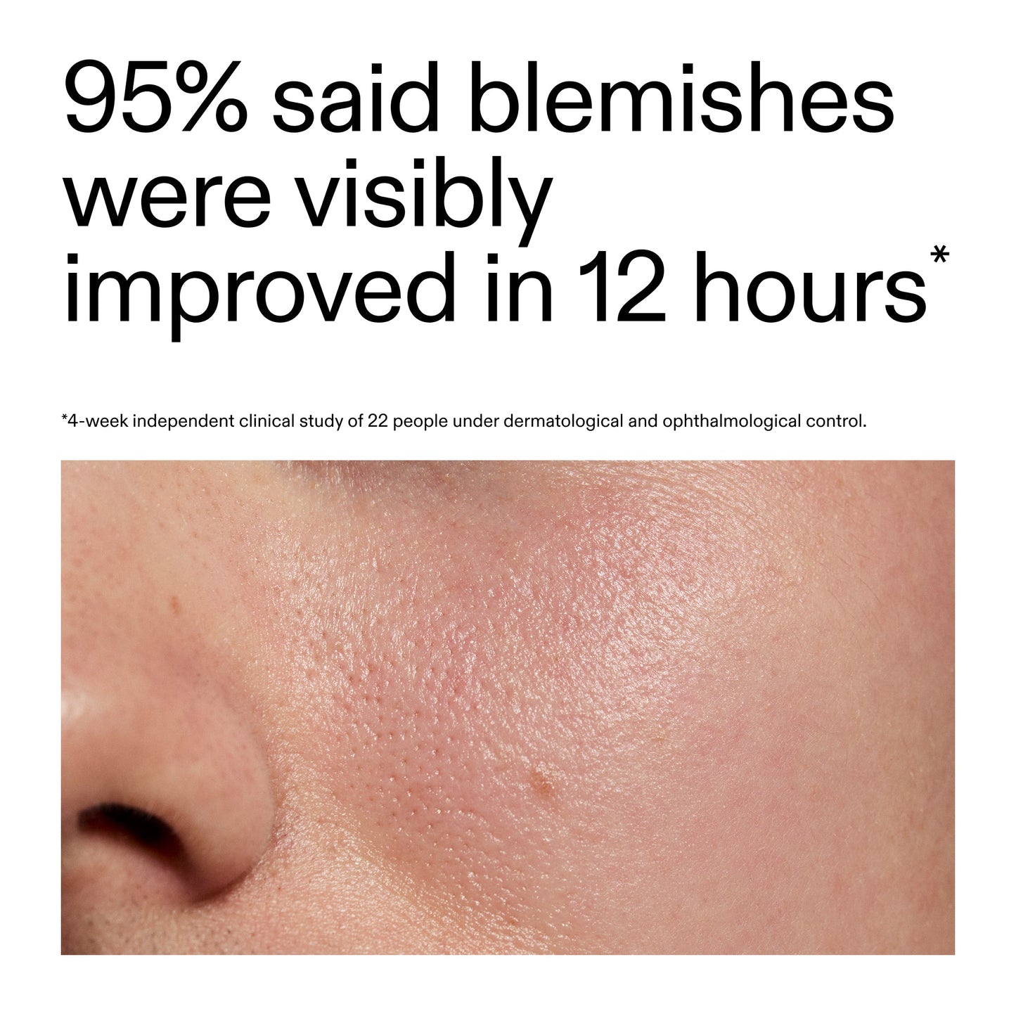 succinic-acid-acne-treatment-b4 Oat_Cleansing_Balm_Claim_2000x2000_ac6ce553-25db-41b2-a981-faae1ac4b8c0.jpg