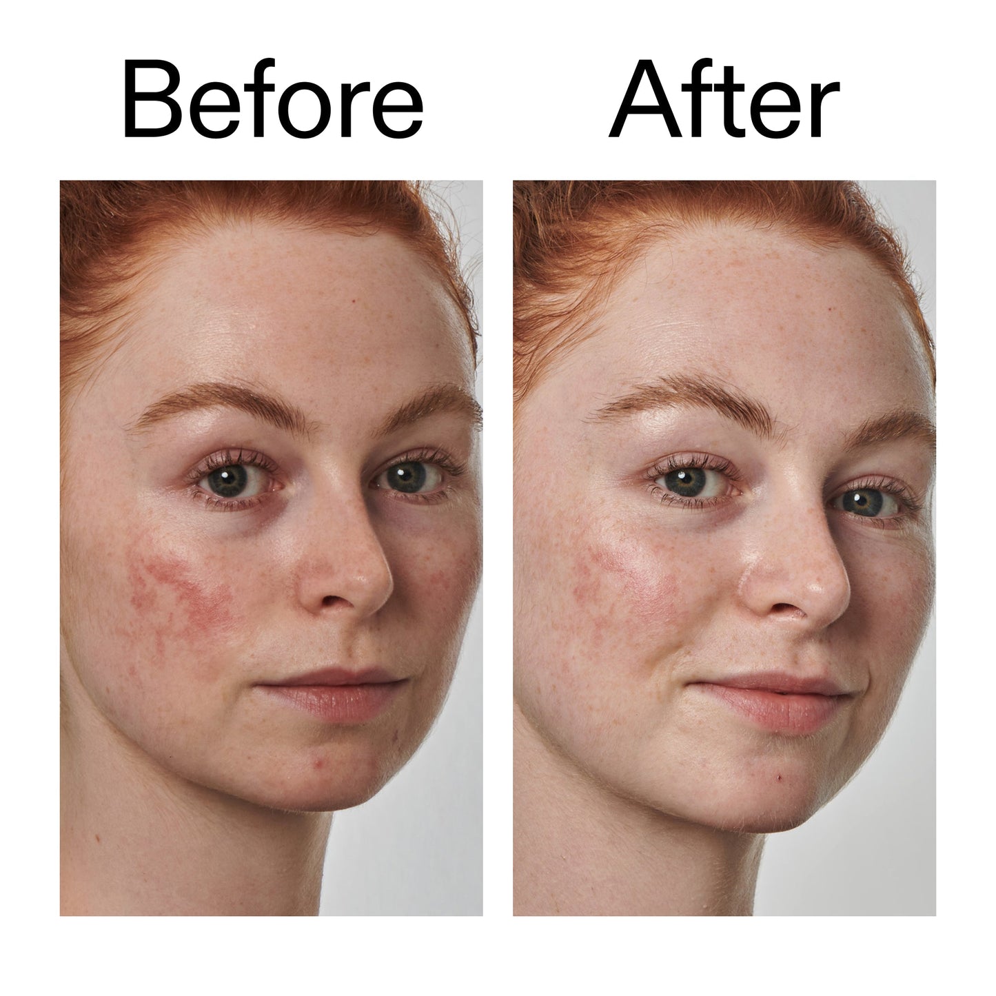 10-azelaic-acid-serum-for-redness-relief-l5 Redness_Relief_Serum_Before_After_2000x2000_3334dc9a-cce9-4e00-8aec-7ad89ca051f2.jpg
