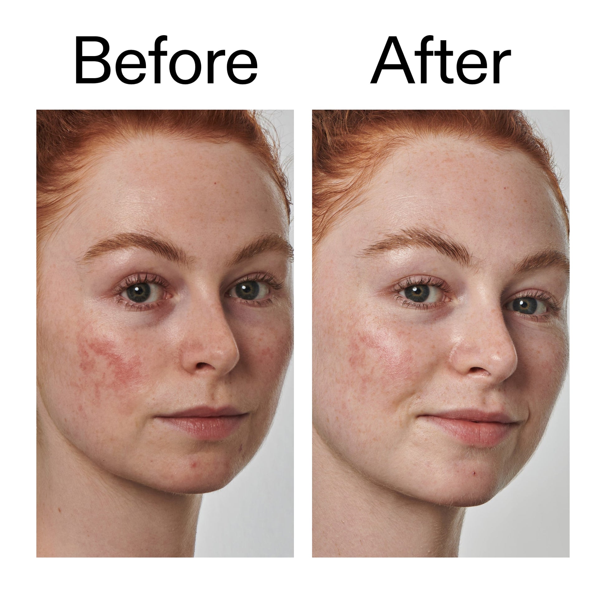 10-azelaic-acid-serum-for-redness-relief-l5 Redness_Relief_Serum_Before_After_2000x2000_3334dc9a-cce9-4e00-8aec-7ad89ca051f2.jpg