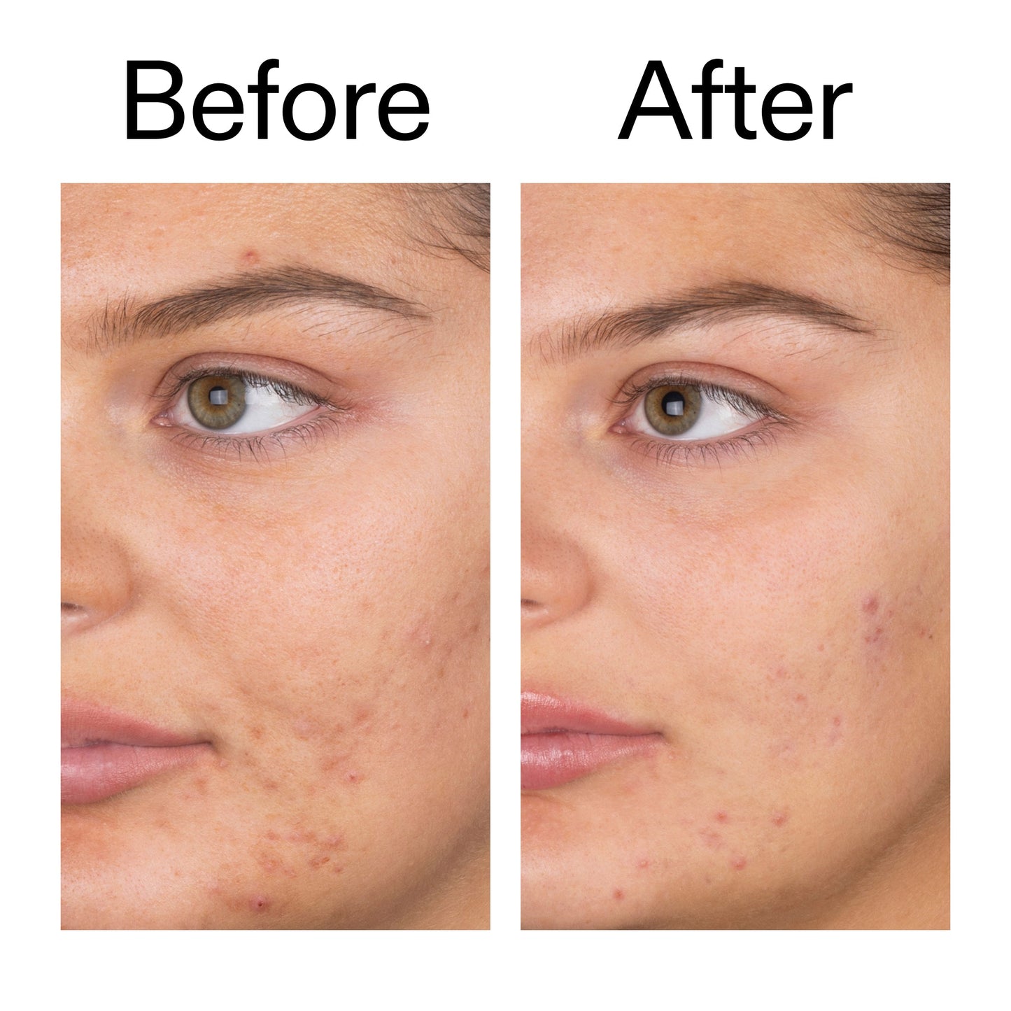 salicylic-acid-cleanser-duo-z6 Salicylic_Acid_Cleanser_-_150ml_Before_After_2000x2000_e7230494-853f-4b07-82b1-27669104c995.jpg