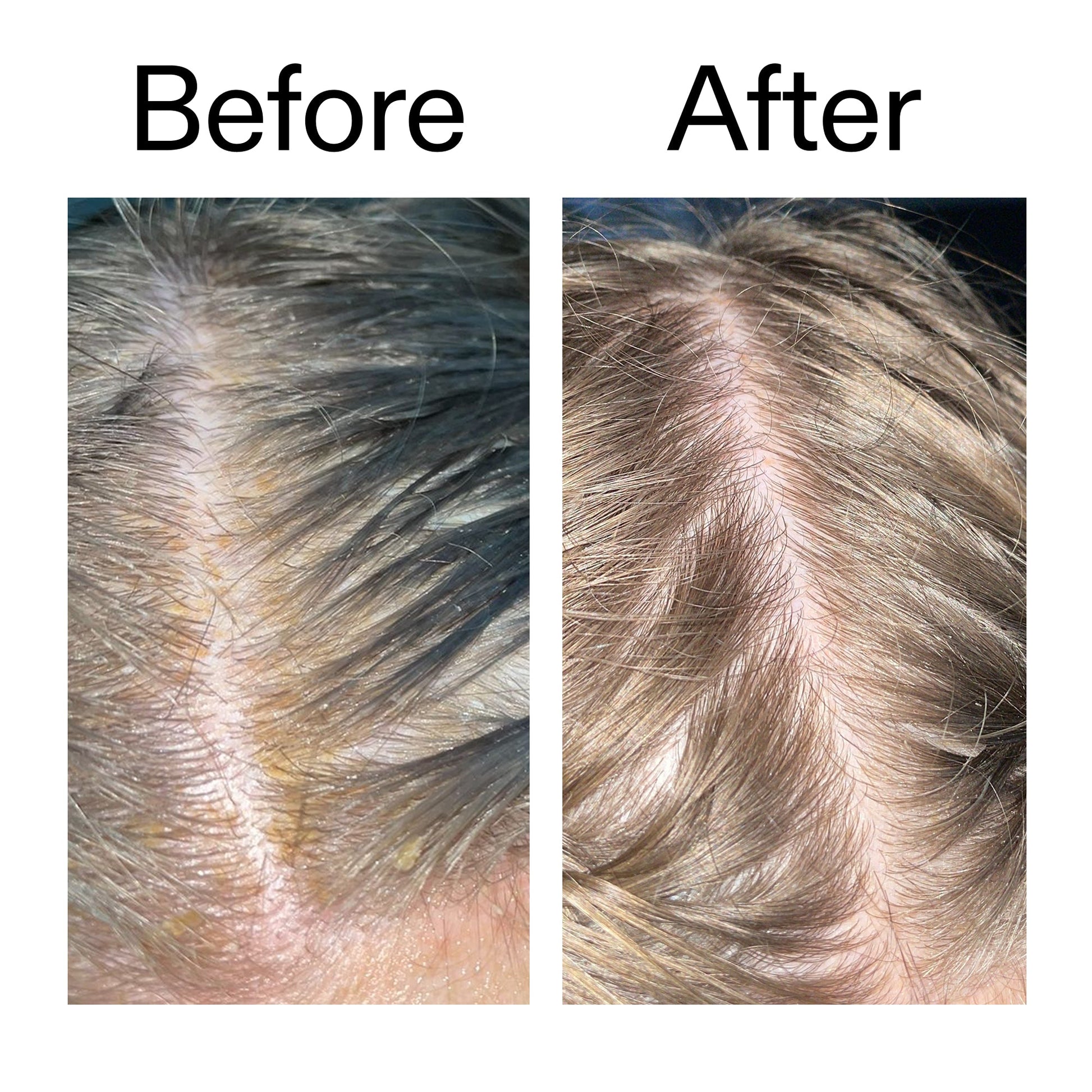 salicylic-acid-exfoliating-scalp-treatment-i1 Salicylic_Acid_Exfoliating_Scalp_Treatment_Before_After_2000x2000_e572a30f-057c-4a48-823b-1c09dc97f8d0.jpg