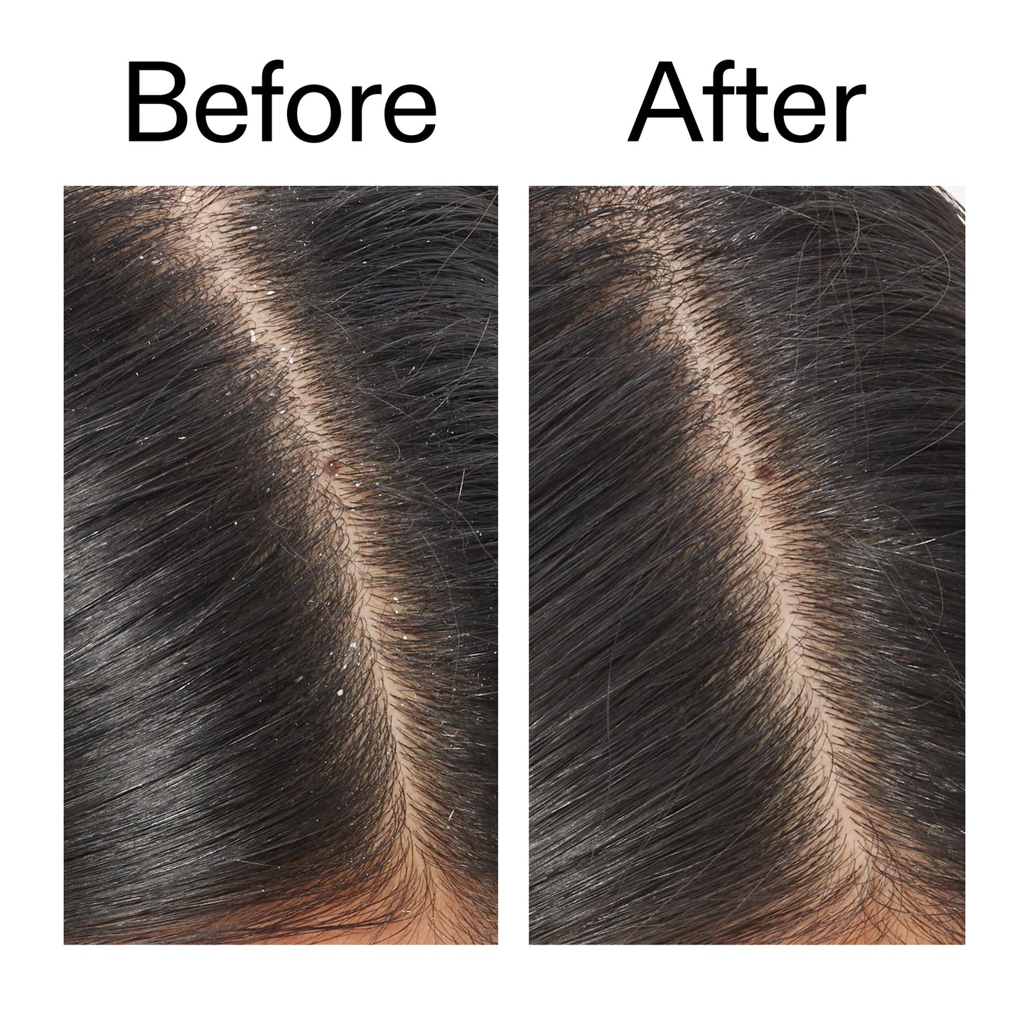 salicylic-acid-exfoliating-scalp-treatment-i1 Salicylic_Acid_Exfoliating_Scalp_Treatment_Before_After_V2_2000x2000_02bd61ad-42bf-490b-b3e3-7e04b2e8a673.jpg