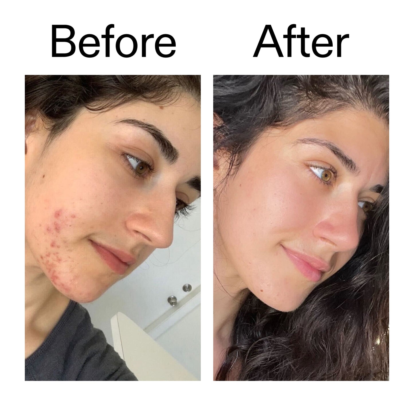 succinic-acid-acne-treatment-b4 Succinic_Acid_Treatment_Before_After_2000x2000_6a5f0054-2f58-4433-9314-0dc72c9bdd3b.jpg