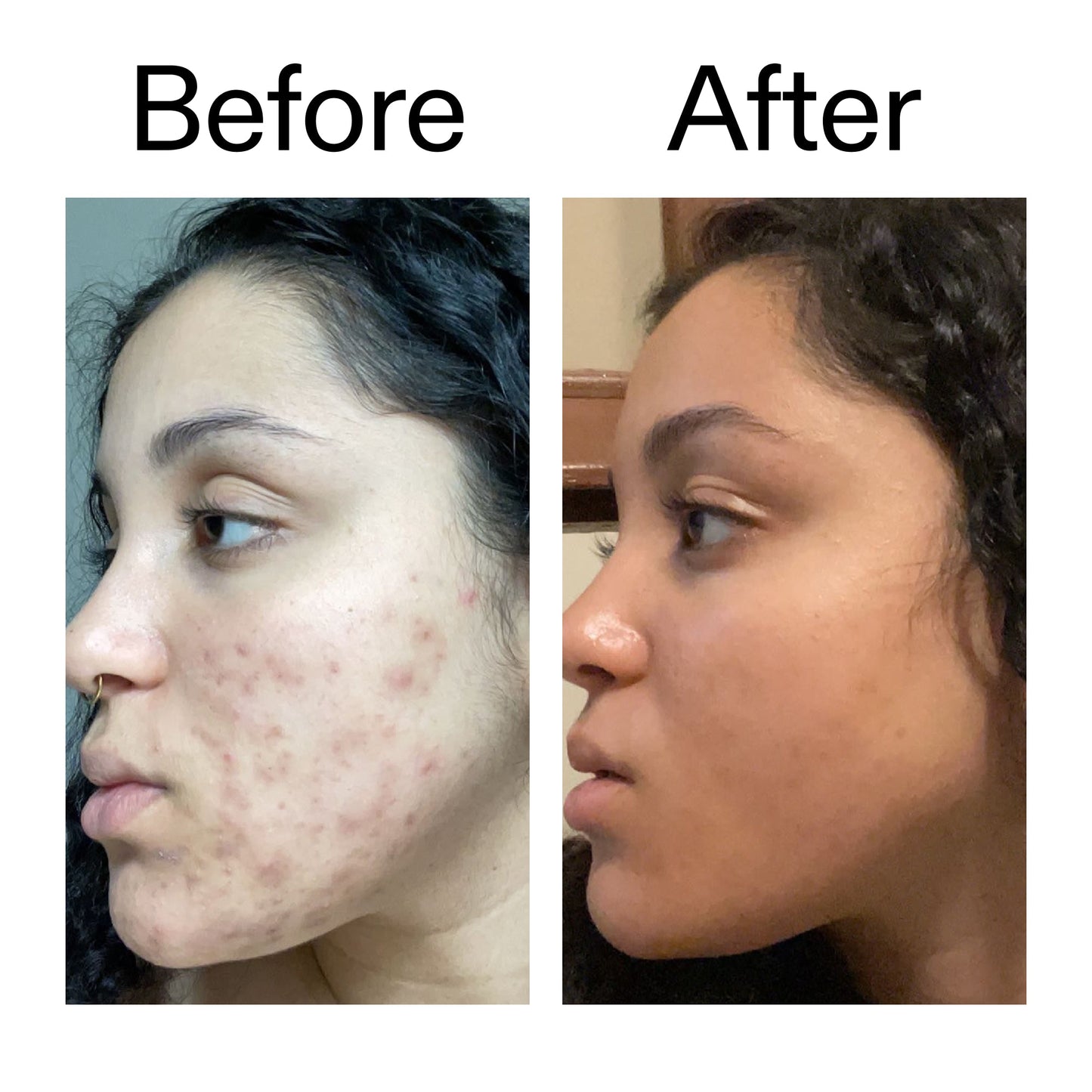 tranexamic-acid-serum-n5 Tranexamic_Acid_Serum_Before_After_2000x2000_98ebc8be-77b0-4843-8a22-90790ebe918b.jpg